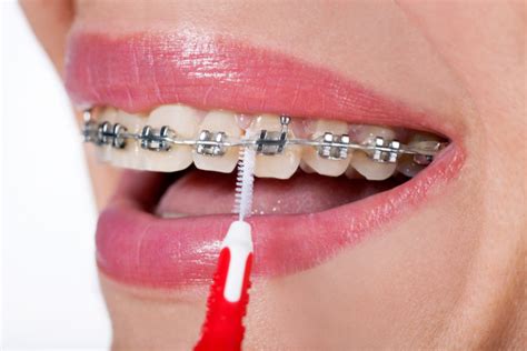 Common Problems With Braces Belmar Orthodontics