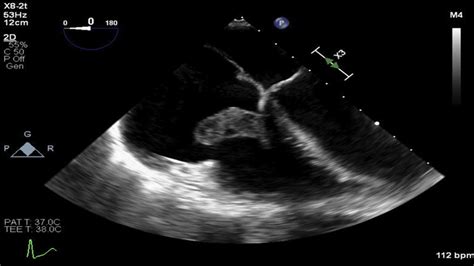 Transesophageal Echocardiogram Showing A Large Tricuspid Valve