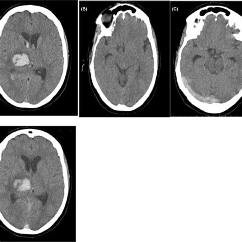 A Brain Computed Tomography Ct Scan At The Time Of Admission