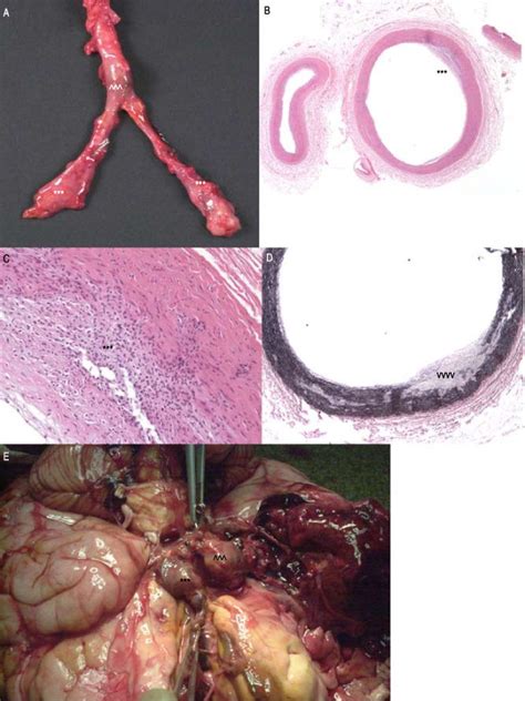 Gross Photograph Aortic And Bilateral Iliac Artery Aneurysms Fig A My