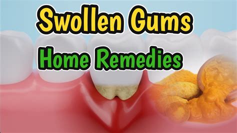 Swollen Gums Home Remedies Tips To Reduce Swollen Gums At Home