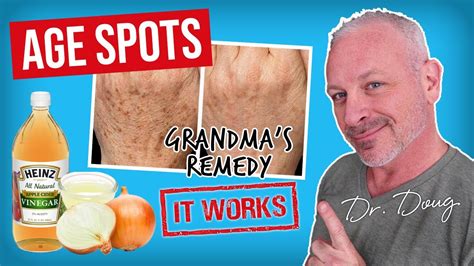 Brown Age Spot Remedy Onion Juice And Acv Youtube