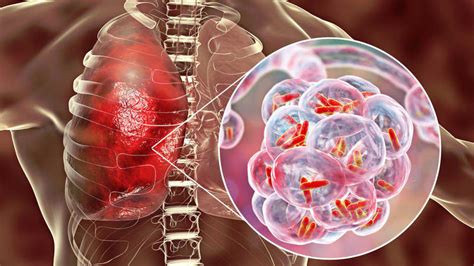 Recursos Para El Control De Tuberculosis