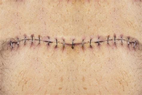 What Is A Pfannenstiel Incision With Pictures