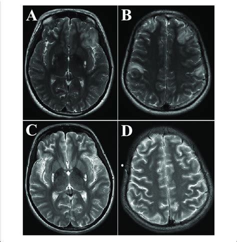The Probands Brain Magnetic Resonance Imaging Mri Obtained At 24