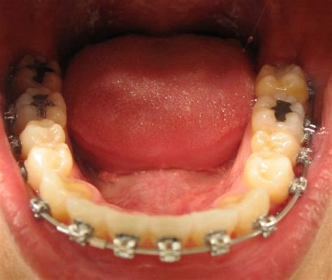 My Journey With The Damon Braces August