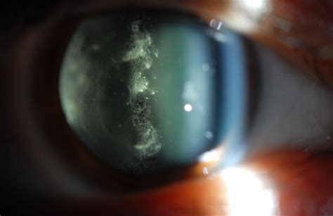 Vitreous Amyloidosis Slit Lamp Photo Retina Image Bank