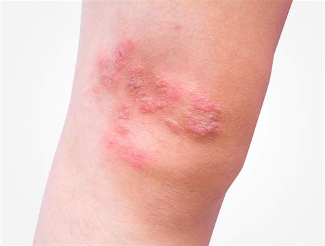 A Knee With Symptoms Of Dermatitis Herpetiformis Dermatitis