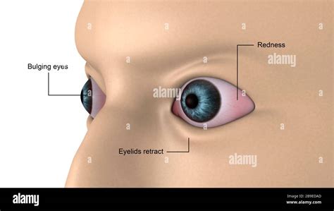 Medical Illustration Of Exophthalmos Bulging Of The Eyes Stock Photo