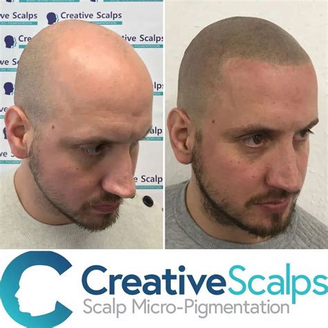 How Much Does Scalp Micropigmentation Cost How Much Cru