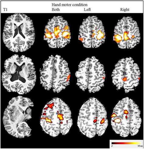 Three Participants Images From Structural And Functional Mri From
