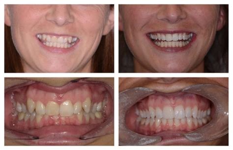 Orthodontic Smile Gallery Cosmetic Dentistry Photos Images