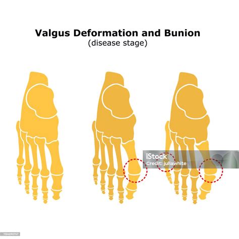 Age And Valgus Deformity Of The Thumb Bunion Stages Of Development Of