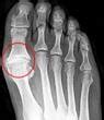 Hallux rigidus Chirurgie Fixer l orteil arthrodèse Orthopédie Roulers
