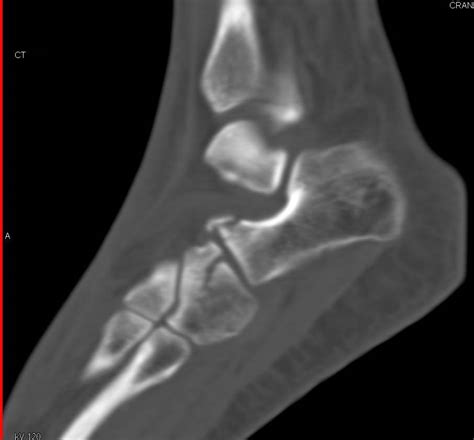 Calcaneus And Cuboid Fractures Trauma Case Studies Ctisus Ct Scanning