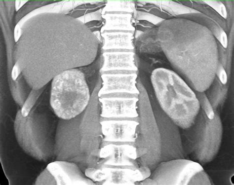 Multiphase Display Of A Renal Cell Carcinoma Kidney Case Studies