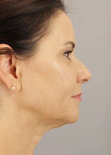 Before And After Face Lift Patient 36 Gallery Robert J Spies Md Facs