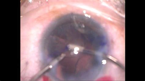 Cataract Surgery And Toric Intraocular Lens Implantation By Druday
