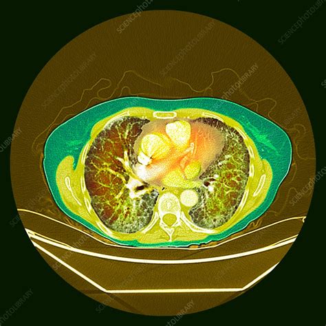 Pulmonary Fibrosis Coloured Ct Scan Stock Image C0372861