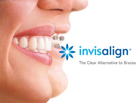 Invisalign And Orthodontics Seattle Smiles Dental