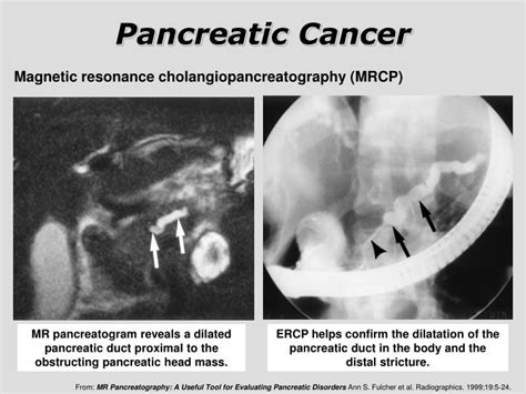 Ppt Pancreatic Cancer Powerpoint Presentation Id6722307