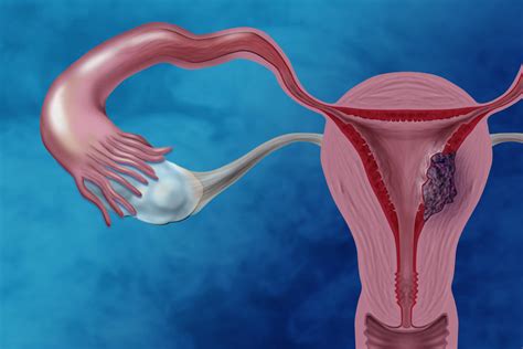 Treating Endometrial Cancer Without Radiation Nci