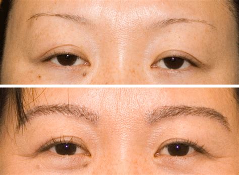 Eyebrow Hair Transplantation |Hair Restoration Surgeon | N ...