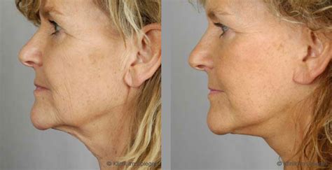 Puderquaste, eyeliner und wimperntusche sollen das gesicht schöner oder einfach ausdrucksstärker machen. Ästhetische Chirurgie | Facelift (Gesichtsstraffung ...