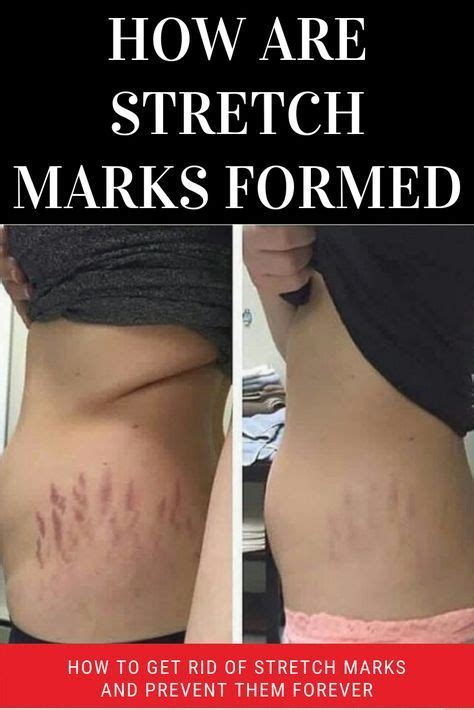 Pin On Stretch Marks Before And After
