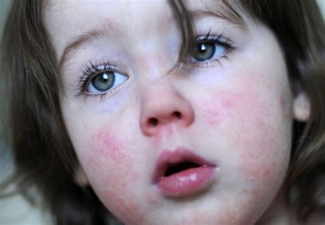 Parents Told To Look For Signs Of Scarlet Fever As Cases Soar In