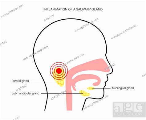 Inflammation Of A Salivary Glands In Human Mouth Parotid