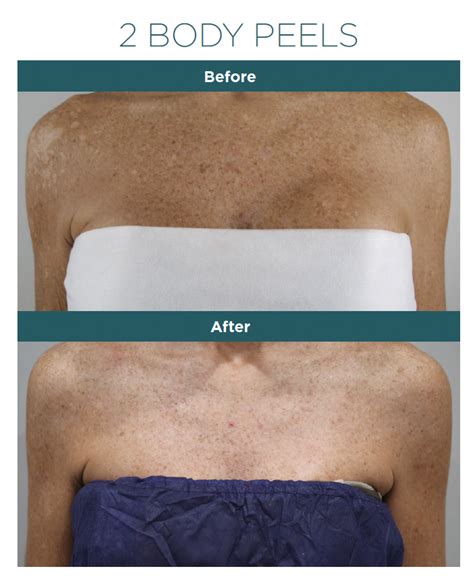 Vi Peel Body Total Body Non Invasive Skin Treatment Drc 360 Medspa