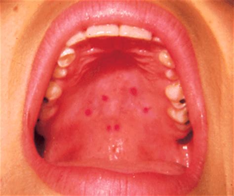 In some cases, sinus infections can also cause painful bumps behind your front teeth. Red Spots on Roof of Mouth | Health Momma