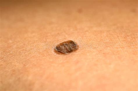 Brown Spot Scaly Flaky Birthmark On Skin Stock Image Image Of