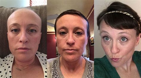 What Helps Hair Grow After Chemotherapy Recovery Katy Hair