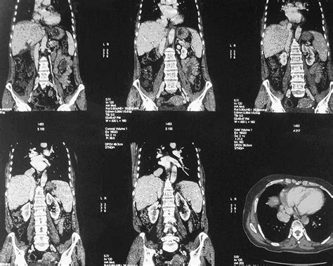 Inferior Vena Cava Aneurysm With Hemothorax Rare Presentation Annals