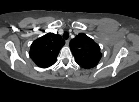 Lymphoma With Nodes In The Left Axilla Chest Case Studies Ctisus Ct