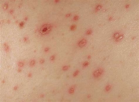 Orticaria: le foto (Foto 10/10) | Salute PourFemme
