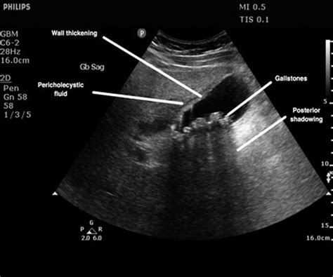 Acute cholecystitis is inflammation of the gallbladder that develops over hours, usually because a gallstone obstructs the cystic duct. Gallstones and Associated Complications from the Emergency ...