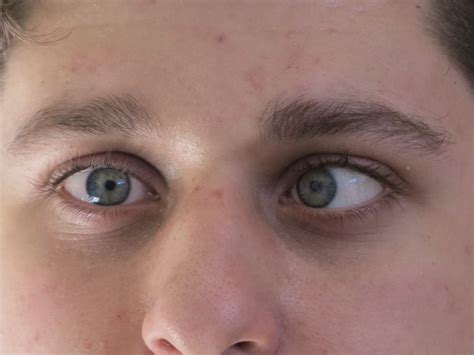 Strabismus A Condition Of Being Wall Eyed Or Cross Eyed Buy Contact