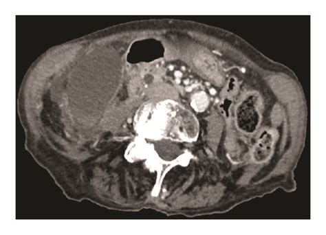 Abdominal Contrast Enhanced Ct Scan Portal Phase Distended Gallbladder