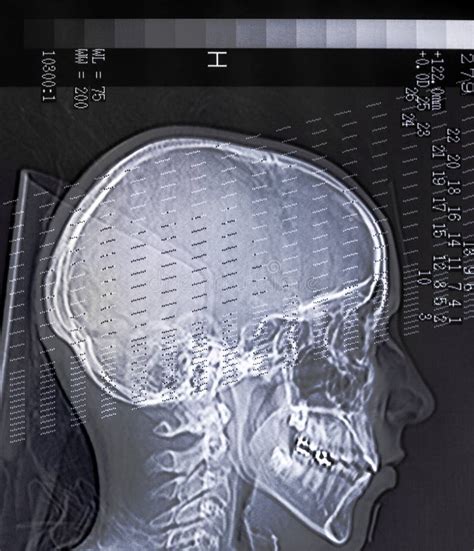 Exploración De La Cabeza De La Radiografía De Una Persona Imagen De