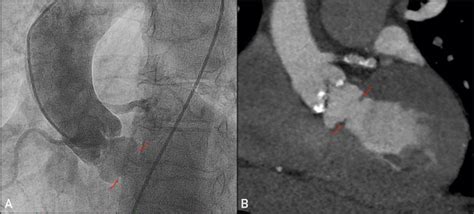 Subaortic Ring A Rare Cause Of Aortic Stenosis In Late Adulthood