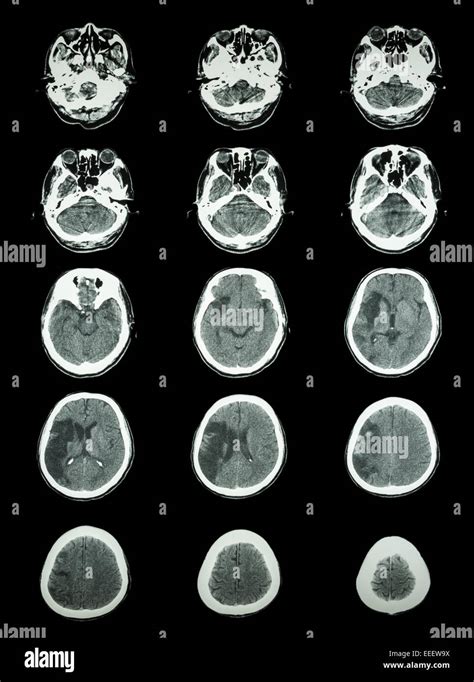 Ct Scan Computed Tomography Of Brain Show Cerebral Infarction At Right Temporal Parietal Lobe