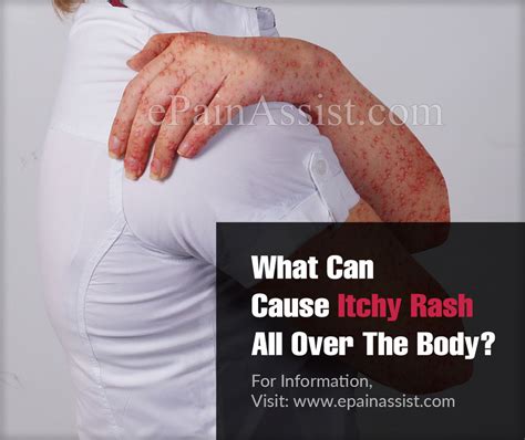 What Can Cause Itchy Rash All Over The Body 2022