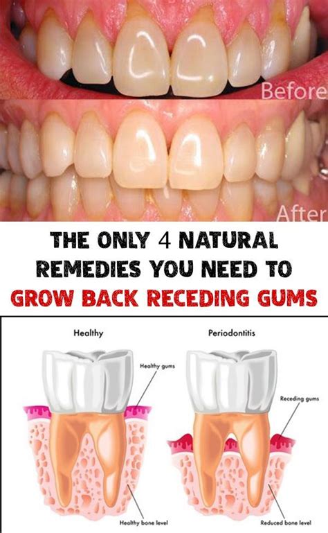 The Only 4 Natural Remedies You Need To Grow Back Receding Gums Grow
