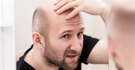 Scientists Discover Potential Cure For Baldness And It Could Be Due