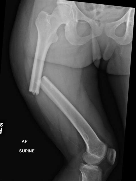 How to set white balance in photoshop ». Nasty femur fracture : Radiology