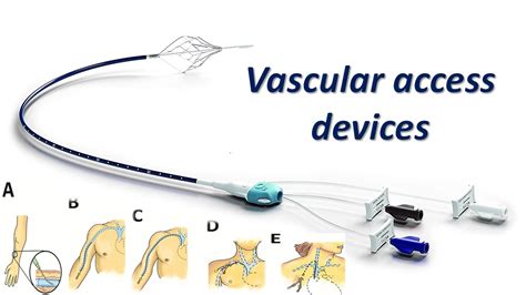 Vascular Access Device Market Forecasted By 2024 Peripheral Vascular
