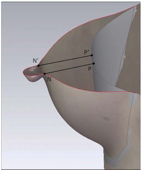 Figure 3 From A Prospective Study Of Breast Dynamic Morphological